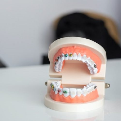 Why a Bite Adjustment Requires a Visit to an Orthodontist